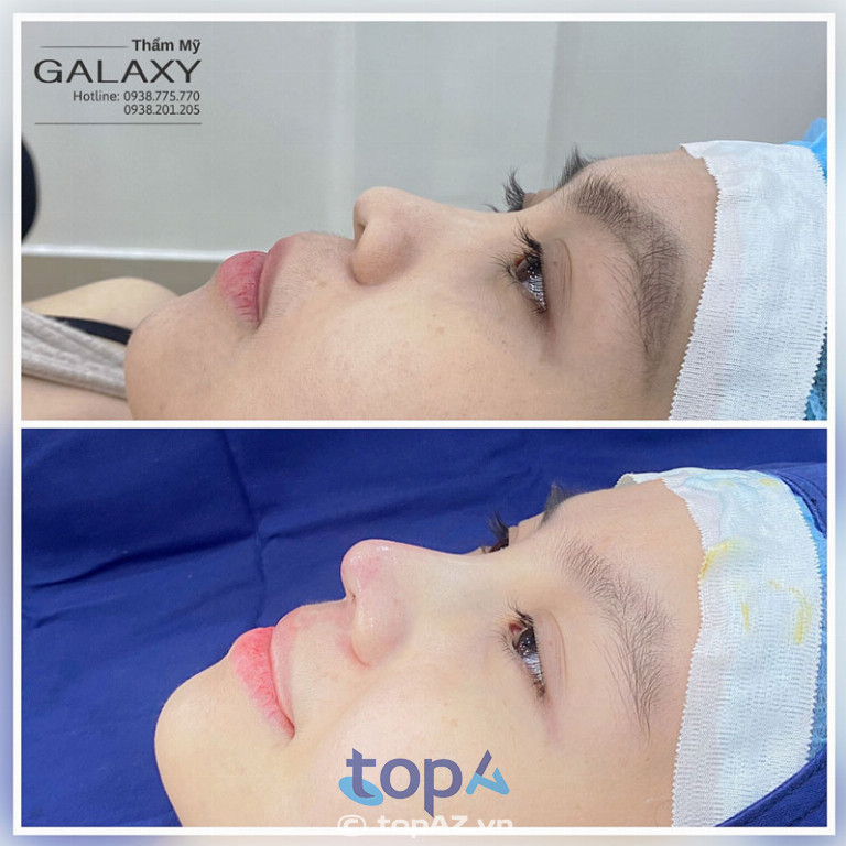 Nâng mũi tại Thẩm mỹ viện Galaxy