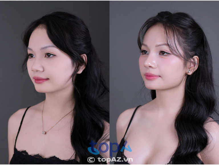 Dáng mũi sau phẫu thuật mềm mại, hài hòa và tự nhiên theo thời gian