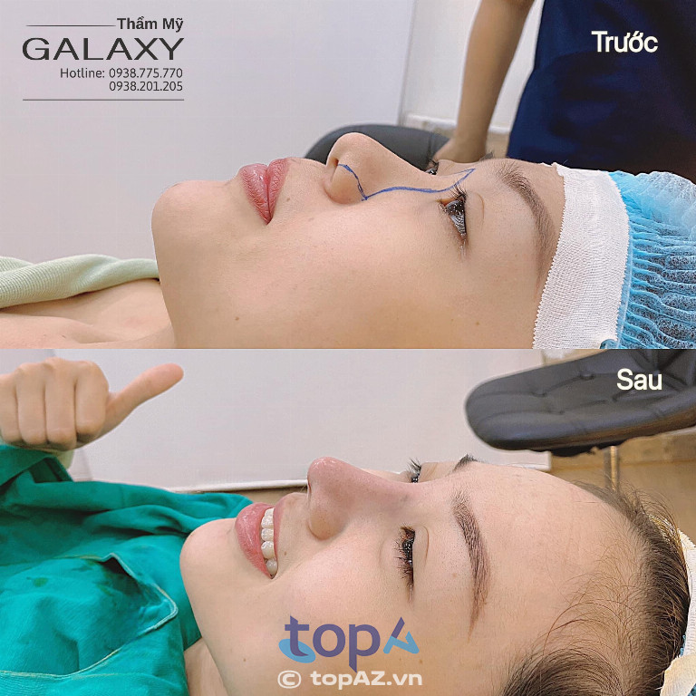 Trước và sau phẫu thuật nâng mũi tại Thẩm mỹ viện Galaxy