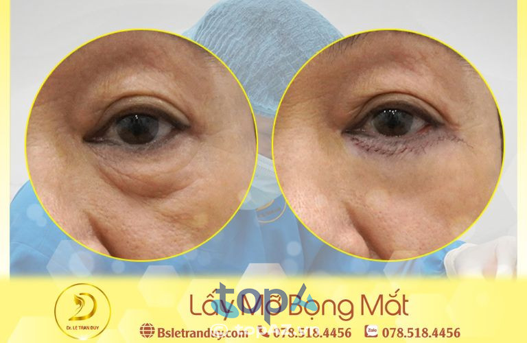 Địa chỉ lấy bọng mắt uy tín tại Tây Ninh