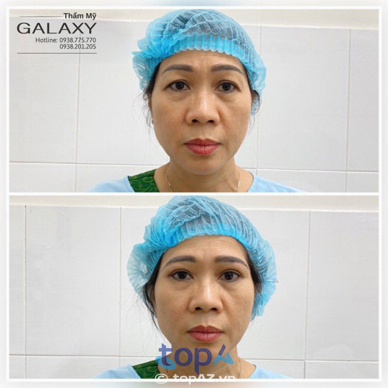 Kết quả trước và sau khi treo cung mày tại Thẩm mỹ viện Galaxy
