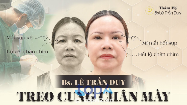 Hình ảnh khách hàng trước và sau khi treo cung chân mày