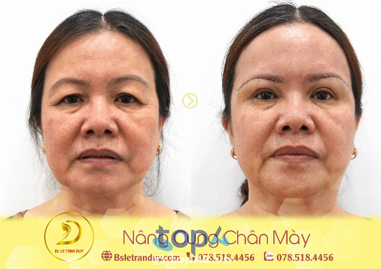 Dịch vụ treo cung mày tại Thẩm mỹ viện Galaxy