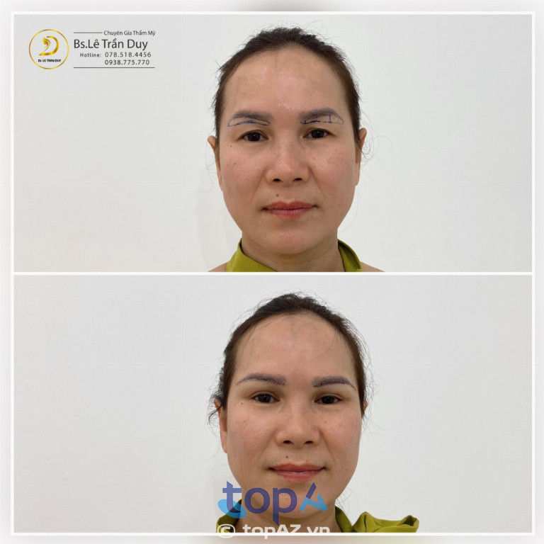 Treo cung mày tại Thẩm mỹ viện Galaxy