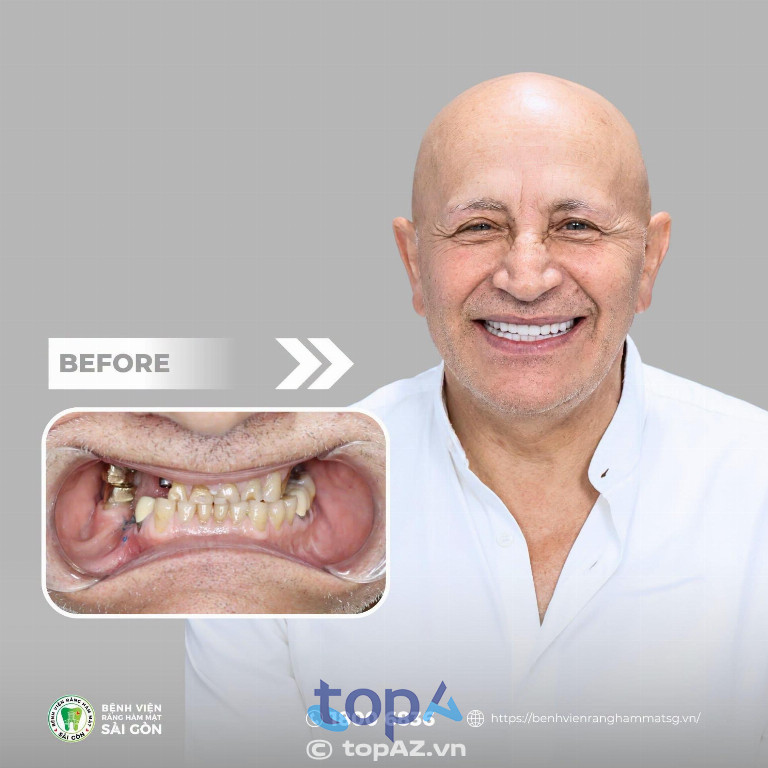 Bệnh Viện Răng Hàm Mặt Sài Gòn đã thực hiện hơn 5.000 ca cấy ghép Implant