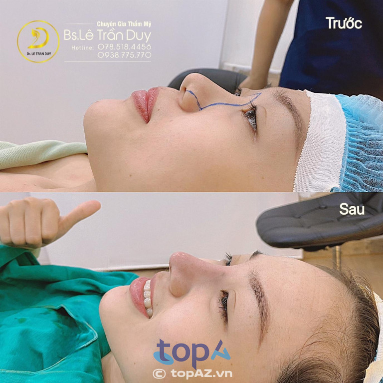 Cá nhân hóa phương pháp thu gọn đầu mũi