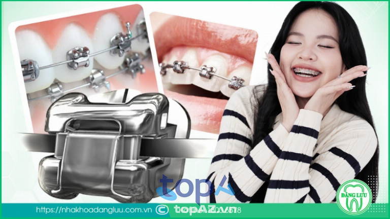 Niềng răng mắc cài kim loại