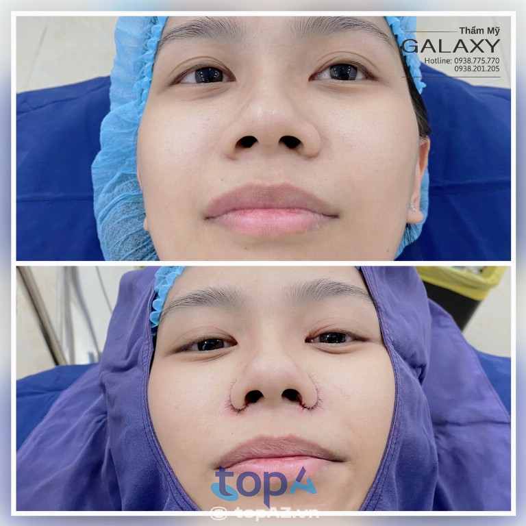 Kết quả thu gọn cánh mũi tại Thẩm mỹ viện Galaxy