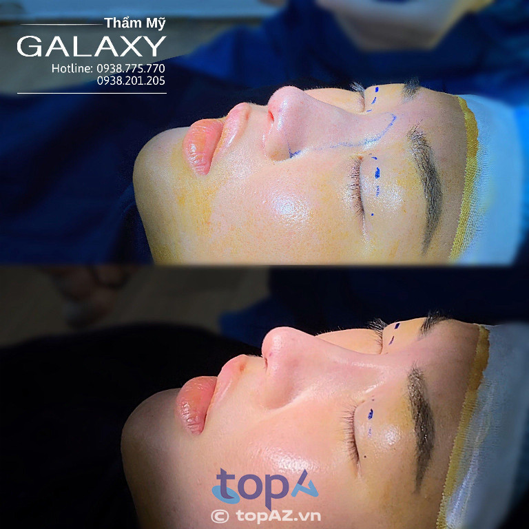 Khánh hàng thẩm mỹ mũi tại Thẩm mỹ viện Galaxy