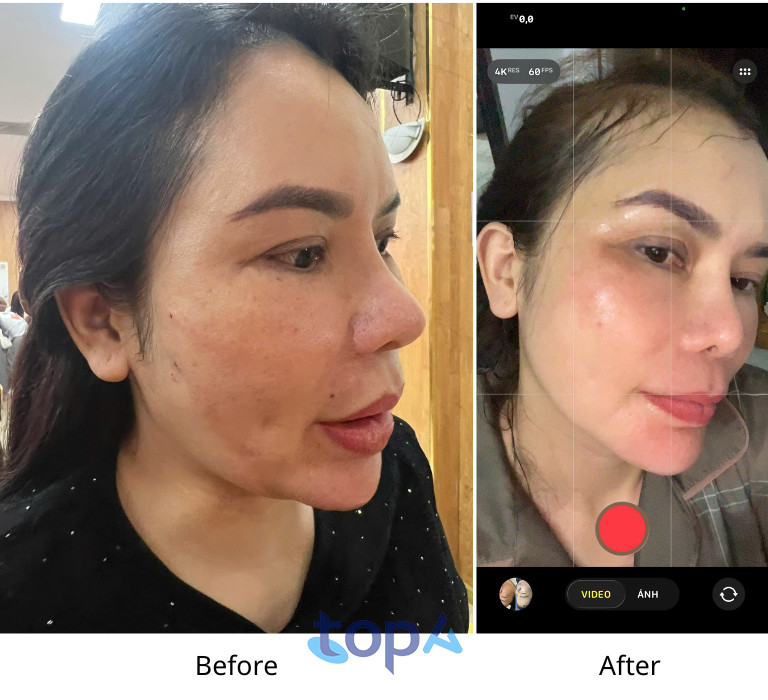 Hình ảnh trước và sau khi trị nám tại Hải Yến Spa Beauty