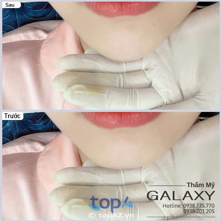 Tiêm filler tại Thẩm mỹ viện Galaxy