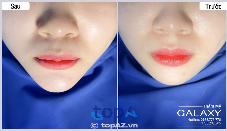 Tiêm filler cằm tại Thẩm mỹ viện Galaxy
