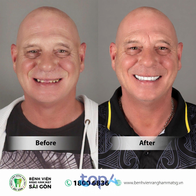 Cá nhân hóa phác đồ Implant