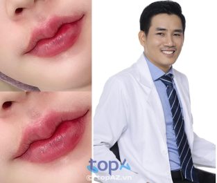 Top 8 địa chỉ cắt môi trái tim tại Vĩnh Long uy tín, BS tay nghề giỏi